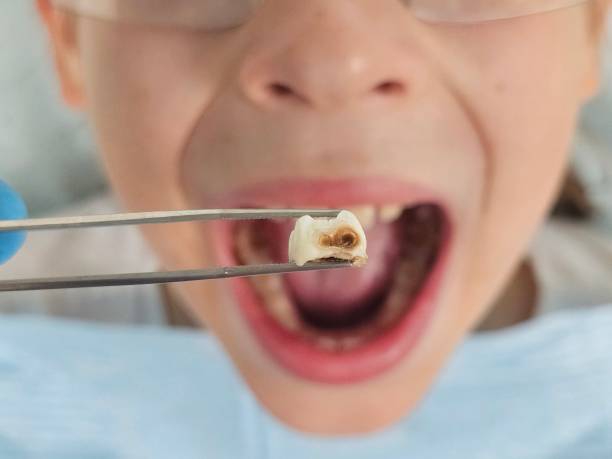 Best Emergency Broken Tooth Repair in Ione, CA